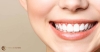 Dúvidas sobre Clareamento Dentário