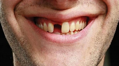Perda dos Dentes