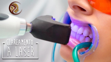 Clareamento Dental a Laser