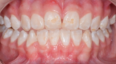 Erosão do Esmalte Dentário