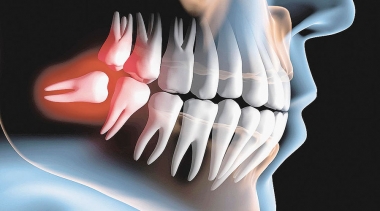 Cirurgia - Odontosecção - Sisos inclusos