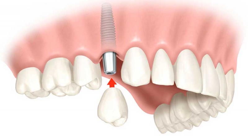 Implante Dentário - Sorria sem vergonha