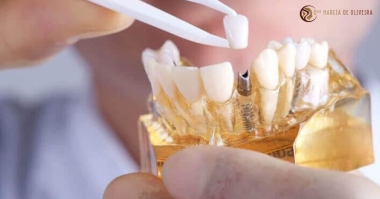 Dúvidas Frequentes - Implantes Dentários