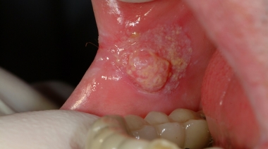 Câncer Oral  - Quais são os sinais e sintomas do câncer de boca?