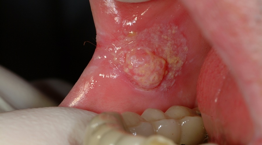 Cancer bucal sintomas iniciales, Papiloma humano lengua sintomas