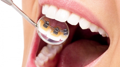 Tudo Sobre Aparelho Ortodôntico - Clínica Odontológica Oral 360 - Dentista  Nova Iguaçu, Tijuca, Copacabana