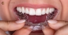 Aparelho dentário invisível e removível - Invisalign