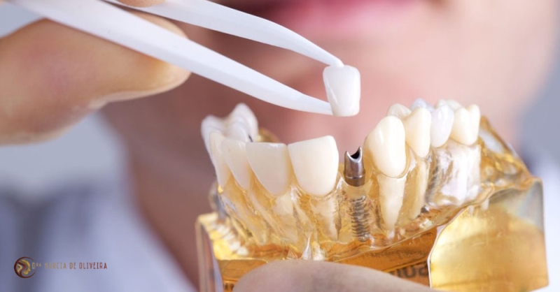 Tipos de Implantes Dentários e suas Indicações