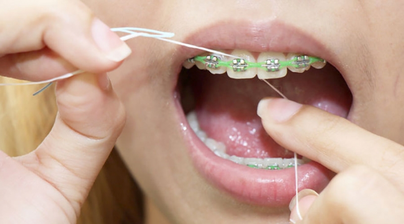 Três Dicas para Facilitar o Uso do Fio Dental com Aparelhos Ortodônticos