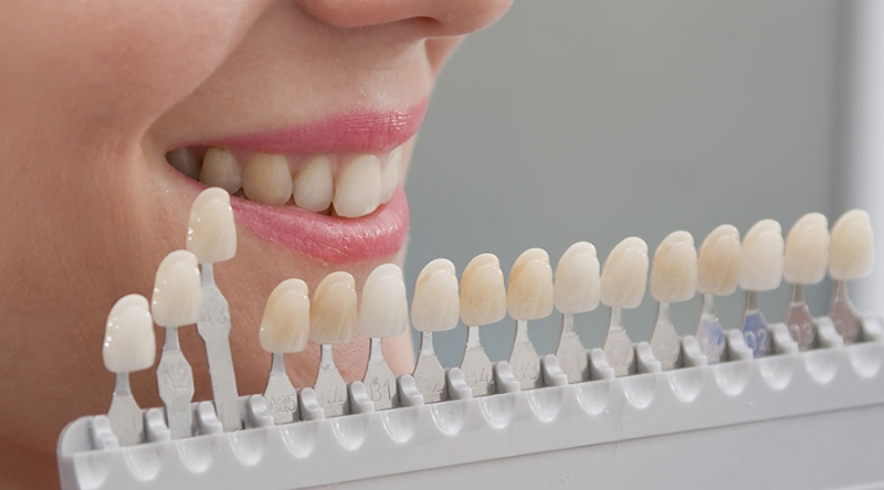 Como Saber a Tonalidade dos Meus Dentes?