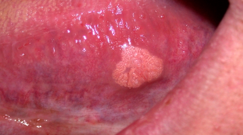 Sintomas del papiloma en la boca - Papiloma en hombres boca Cancer malign la ochi