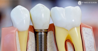 Tipos e Técnicas de Implantes Dentários