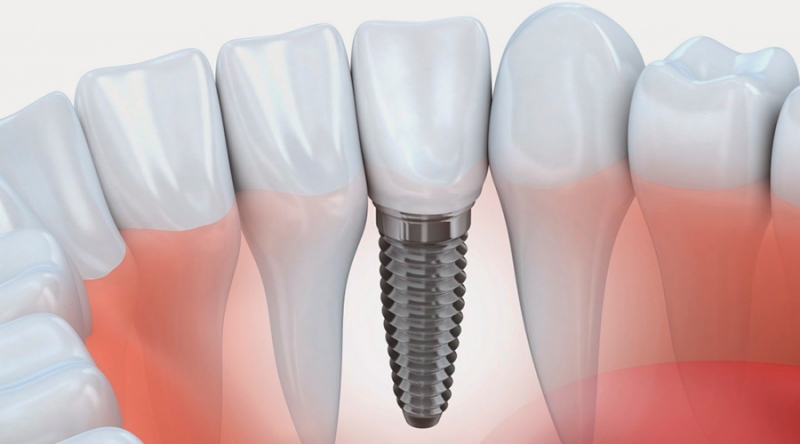 Quais fatores podem comprometer a realização do Implante Dentário?