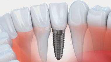 Quais fatores podem comprometer a realização do Implante Dentário?