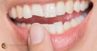 O que é Restauração Dentária?