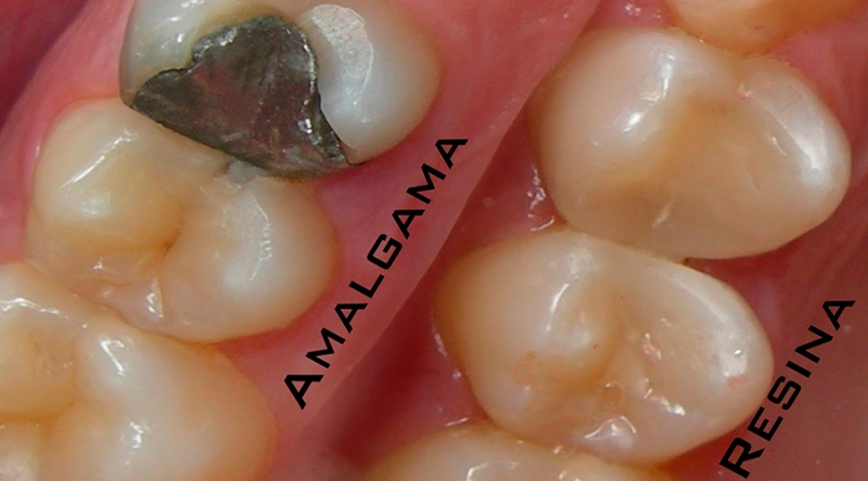 Restauração dentária em amálgama ou resina?