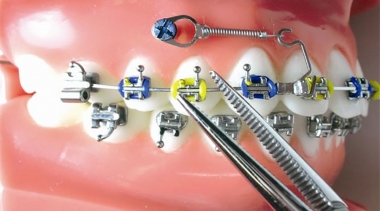 Fazer implantes dentários antes ou depois do tratamento ortodôntico?