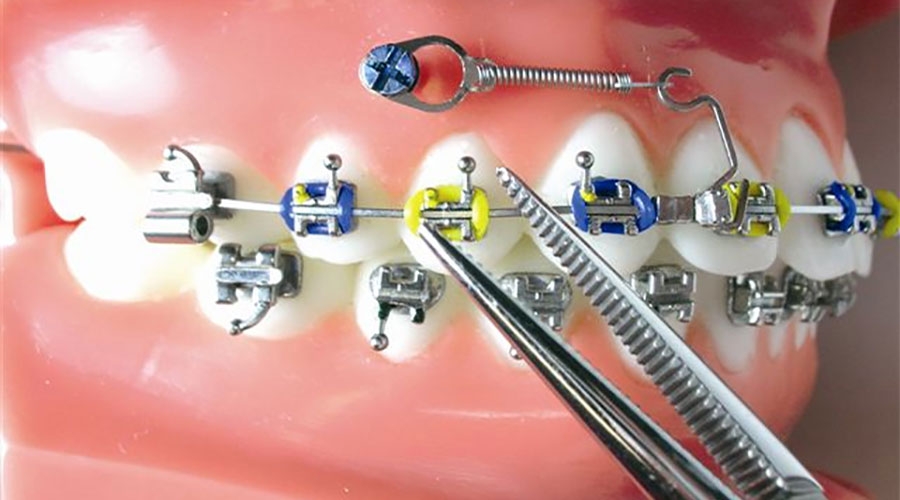 Fazer implantes dentários antes ou depois do tratamento