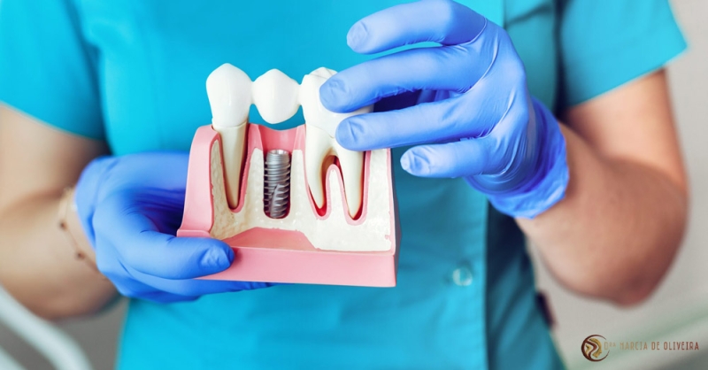 A Peri-implantite pode causar a perda de implantes dentários.