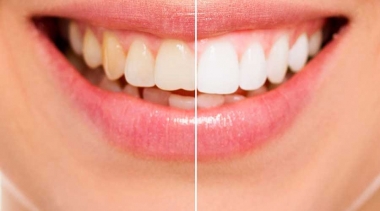Clareamento Dental - Seu sorriso é o seu cartão de visita!