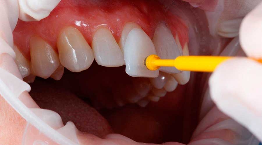 Qual a Diferença entre Faceta em Porcelana e Lente de Contato Dental