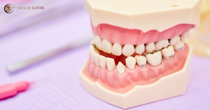 Principais Causas da Má Oclusão Dentária