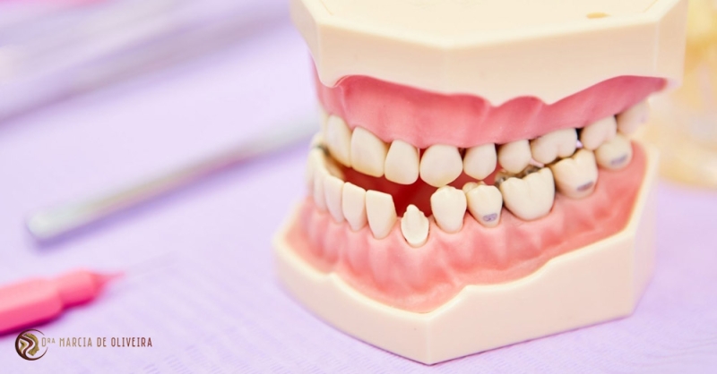 Tipos de Má Oclusão Dentária