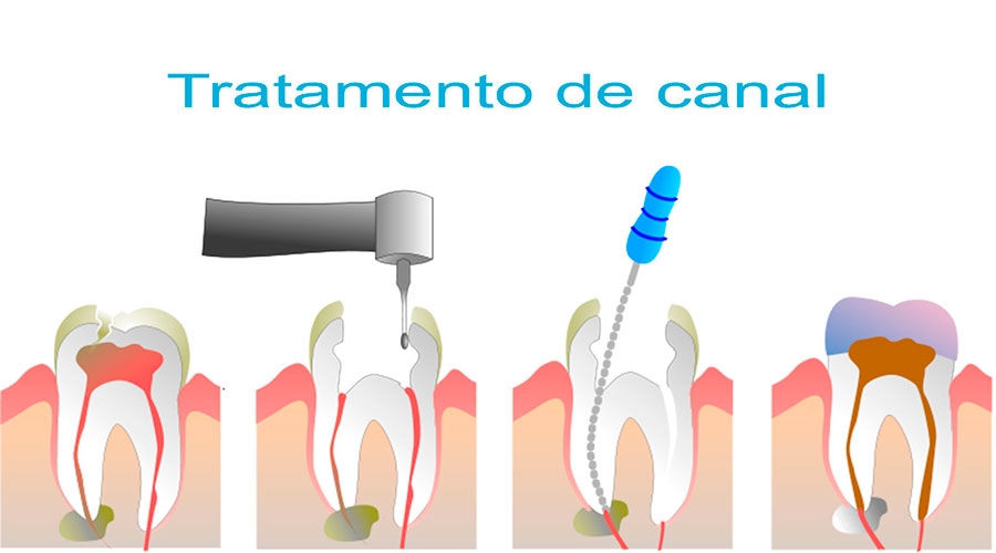 O que é tratamento Endodôntico Clínica Odontológica em Copacabana Dentista em Copacabana